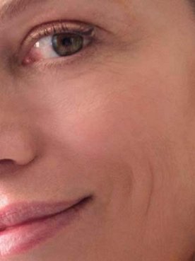 acido hialuronico para rostro perfecto