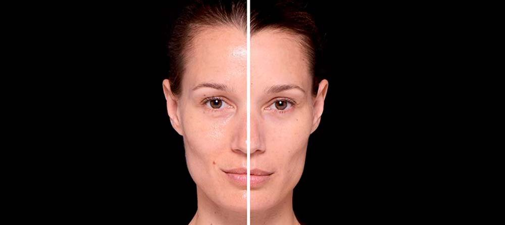 como eliminar espinillas sin dejar marca