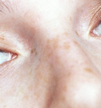 Como Elegir El Corrector Adecuado Para Deshacerme De Las Ojeras