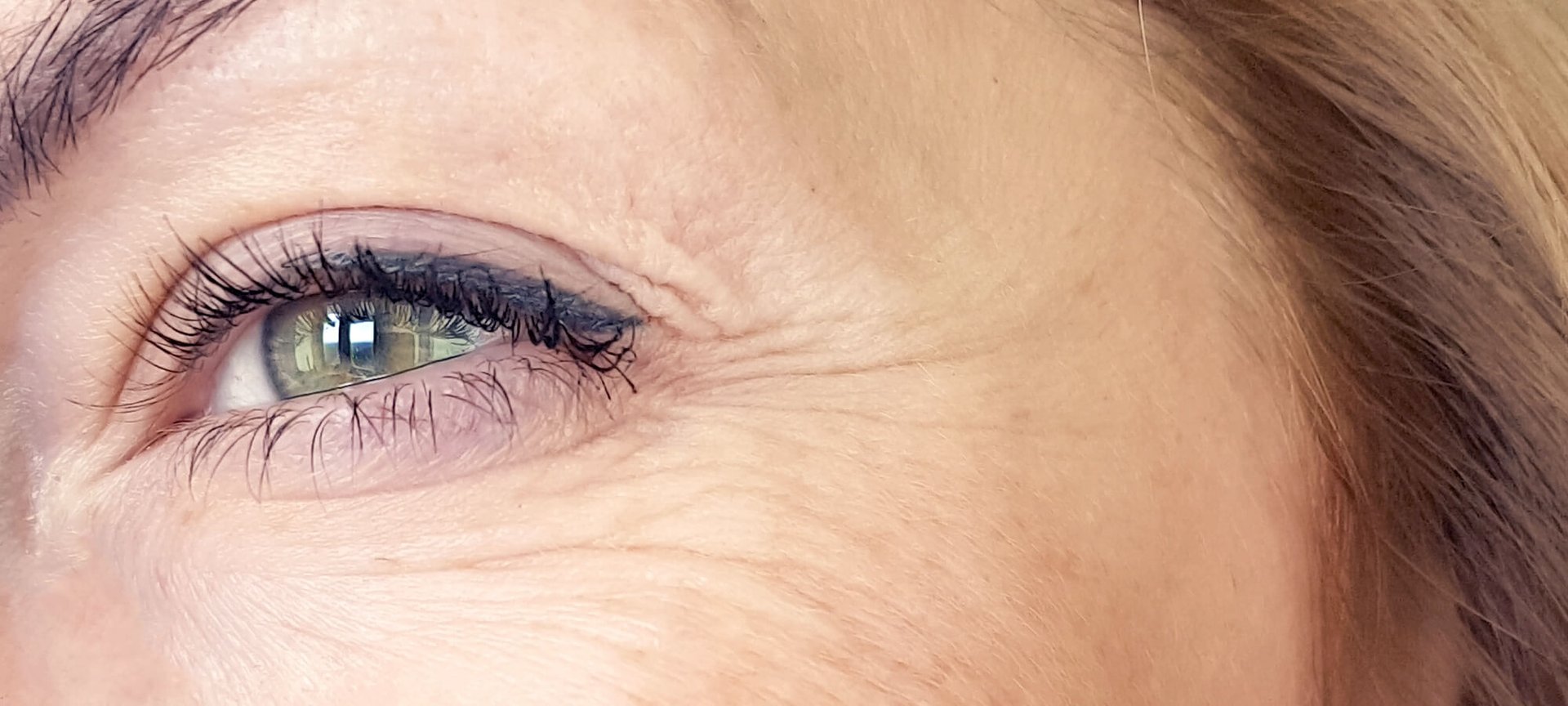 Me Estan Apareciendo Arrugas Verticales Bajo Los Ojos