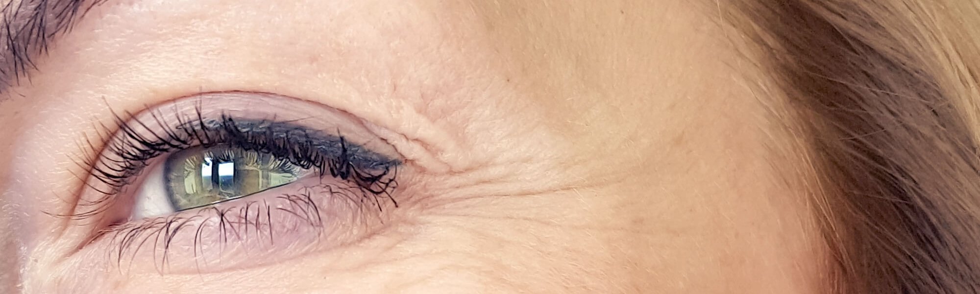 Me Estan Apareciendo Arrugas Verticales Bajo Los Ojos