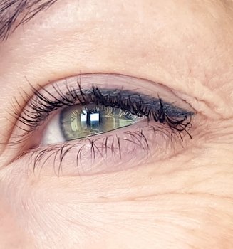 Me Estan Apareciendo Arrugas Verticales Bajo Los Ojos