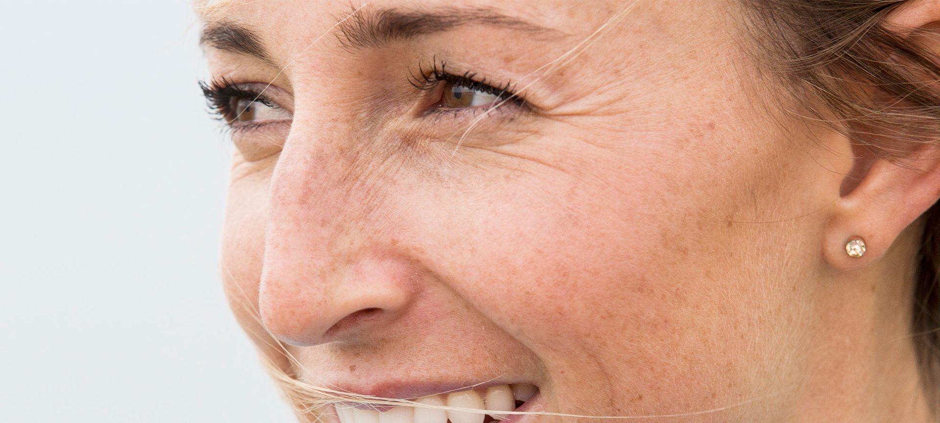 remedios eliminar arrugas ojos